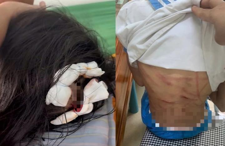 Xác minh vụ bé gái lớp 5 nghi bị cha dượng bạo hành dã man